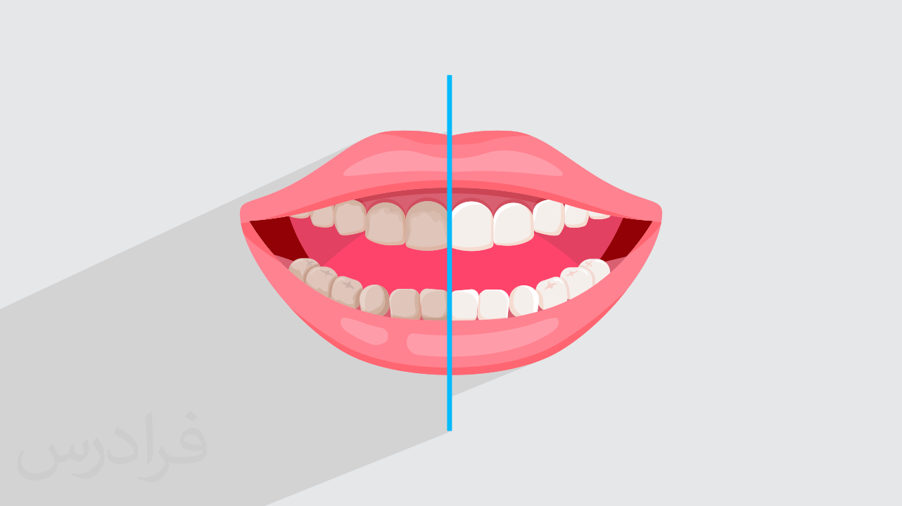 بلیچینگ یا سفید کردن دندان – آموزش ۳ روش مختلف